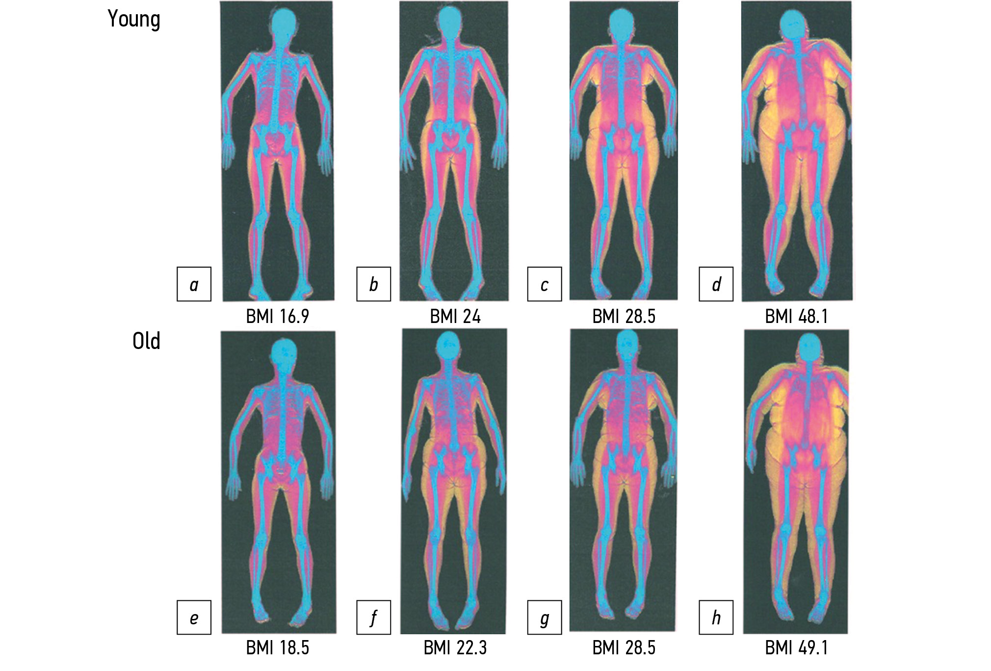 of osteoporosis related to sarcopenia and its components according to