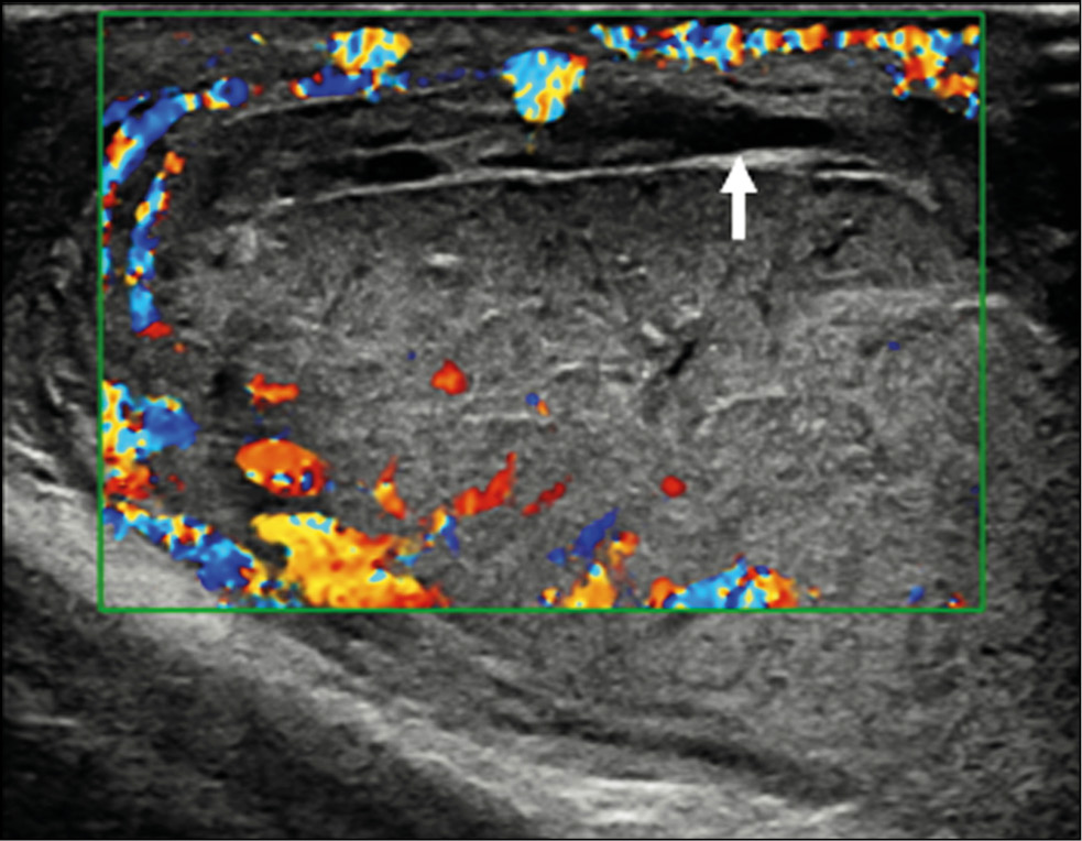 Orchiectomy after testicular trauma in a 45-year-old man A case report -  ScienceDirect