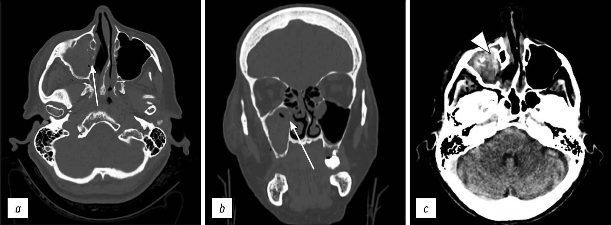 pterygoid plate fracture