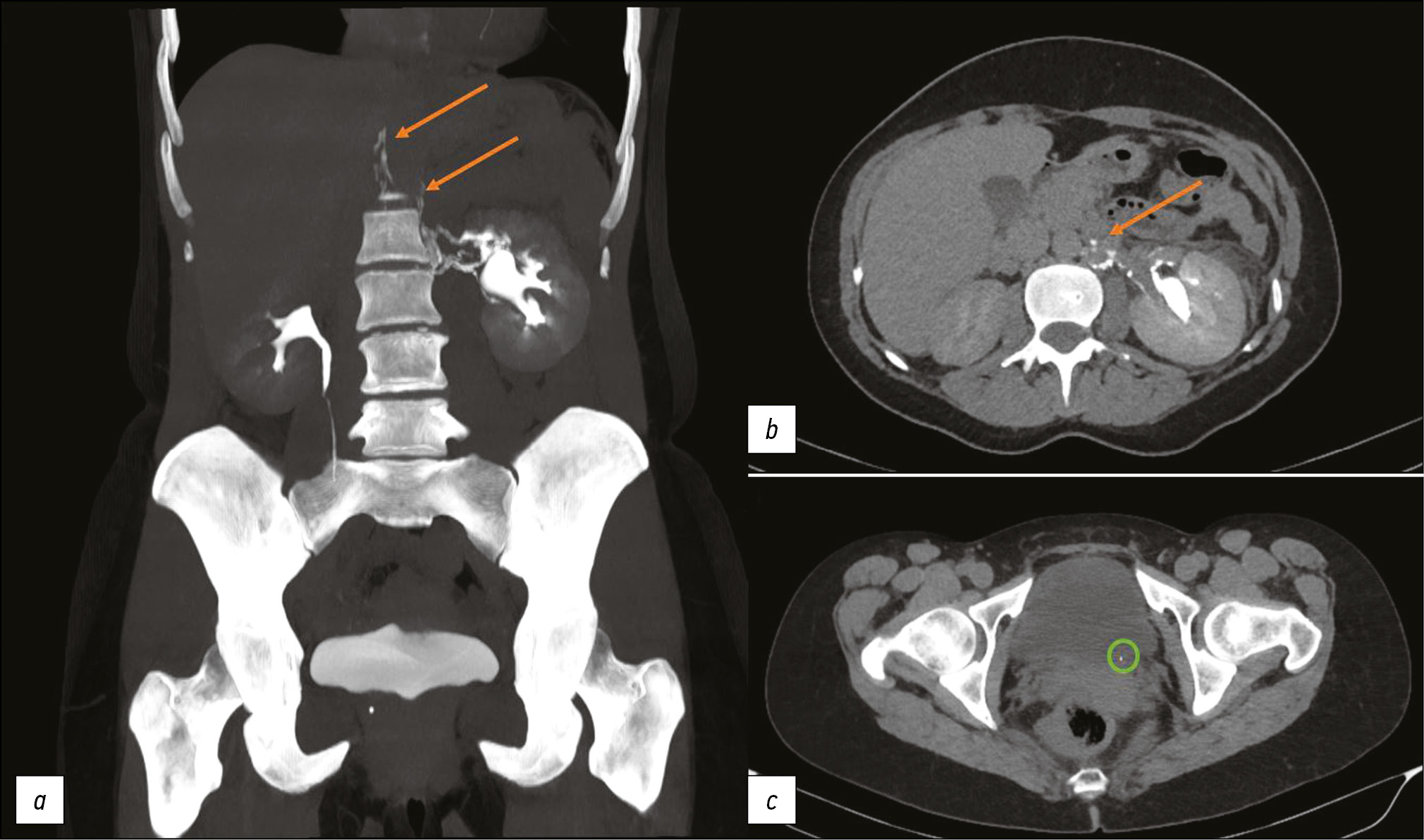 Computer tomography of uro-lymphatic fistulas associated with renal colic