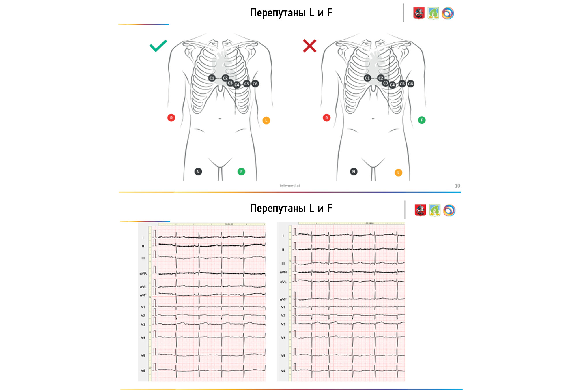 Creation of a training and test dataset with the disposition and transposition of overlaying electrocardiographic electrodes when recording electrocardiograms-12