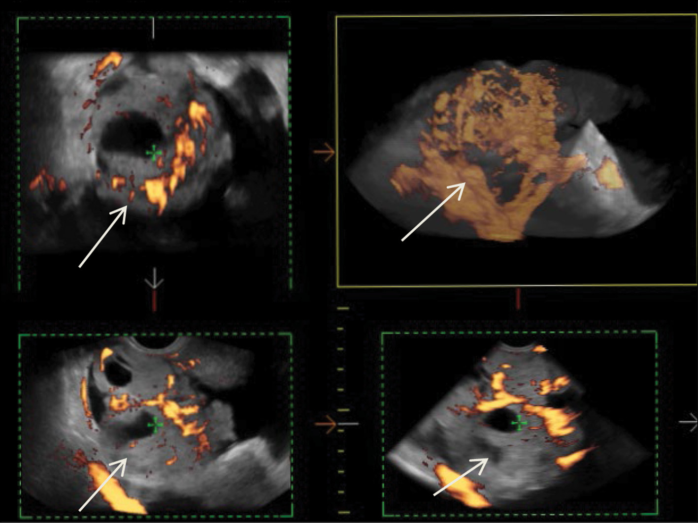 Radiation methods in the diagnosis of primary and recurrent malignant ovarian struma: A case report