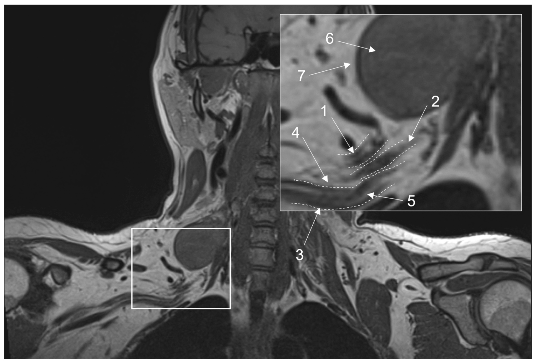 Conventional magnetic resonance imaging of peripheral nerves: MR-neurography