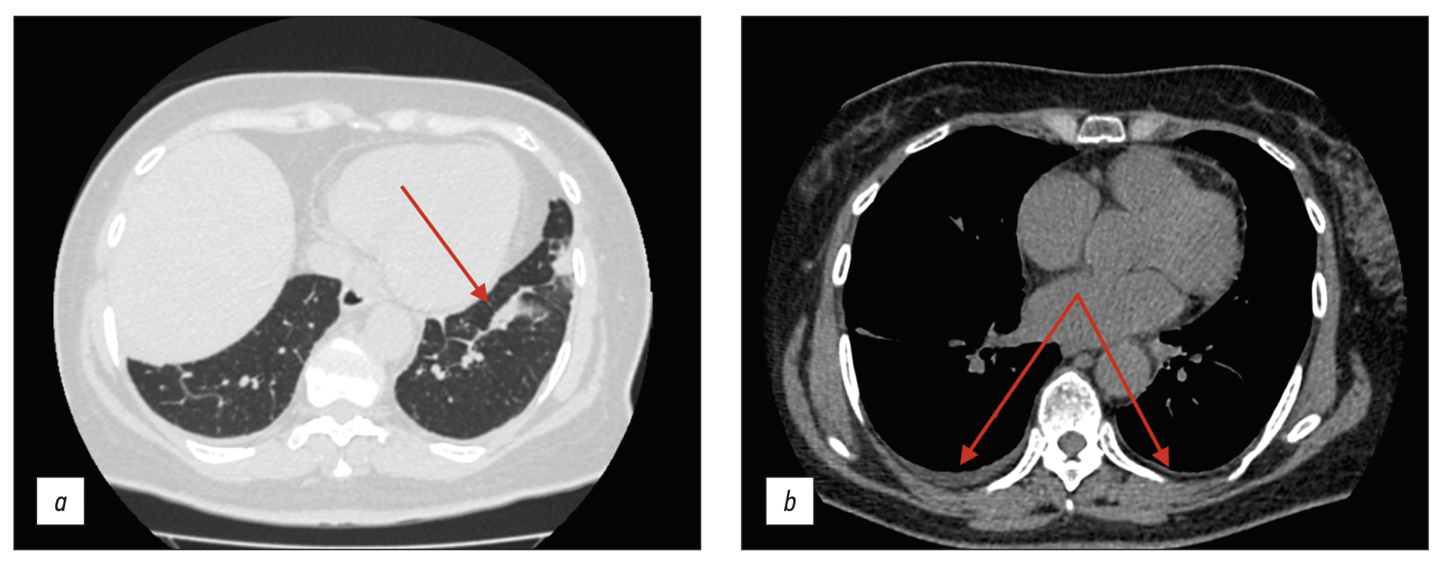 Computed tomography in the diagnosis of fever of unknown origin: A case report
