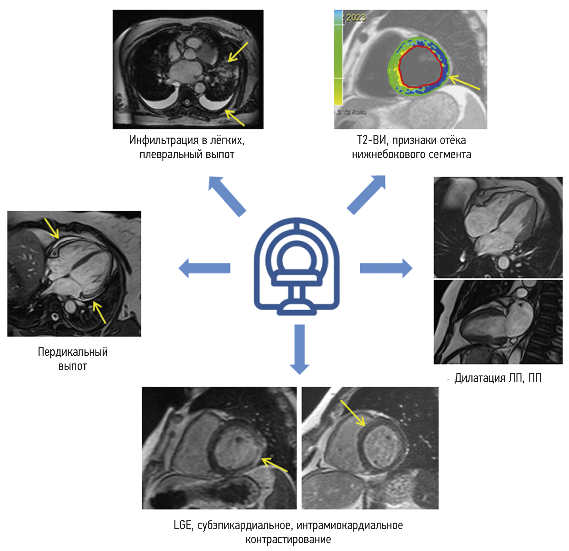 Cardiac magnetic resonance imaging in patients with history of COVID-19