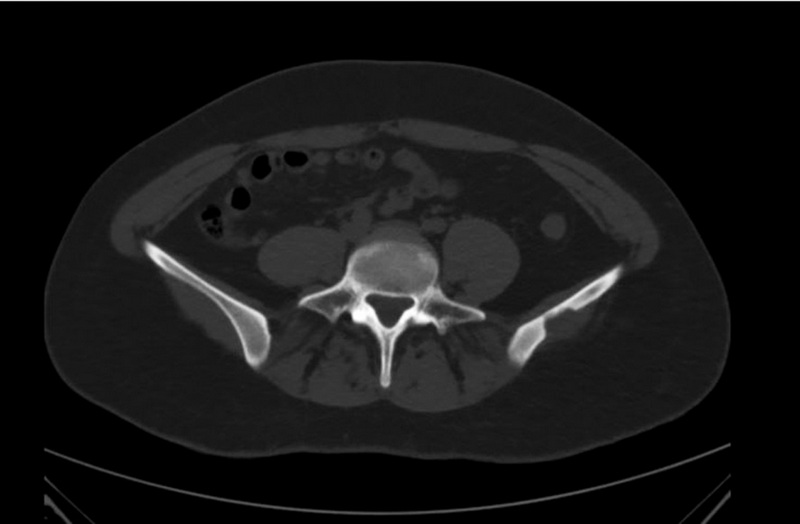 Diagnosis of solitary eosinophilic granuloma by CT, MRI, and 18F-FDG PET/CT: two clinical cases