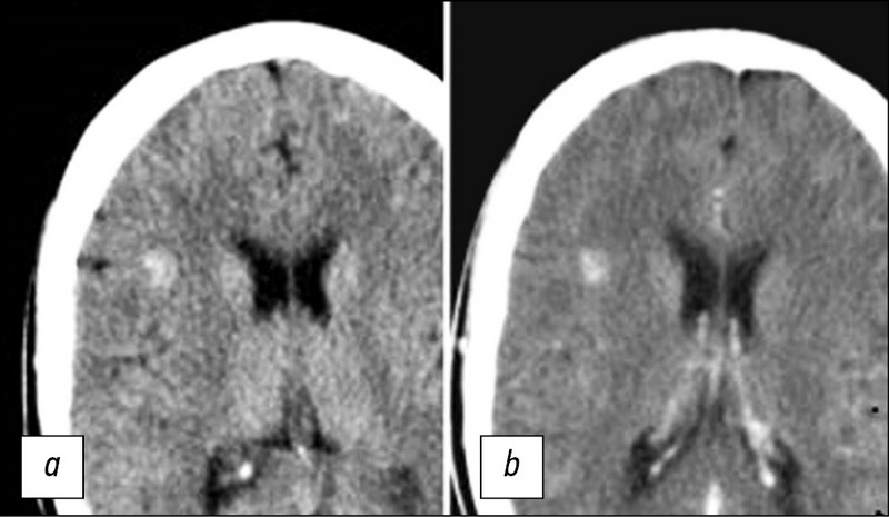Radiation diagnostics of cerebral cavernous malformations