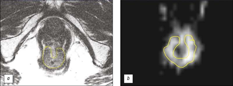MRI evaluation of the neoadjuvant chemoradiation therapy result in a patient with rectal cancer, supplemented with T2-WI texture analysis of the tumor: a clinical case
