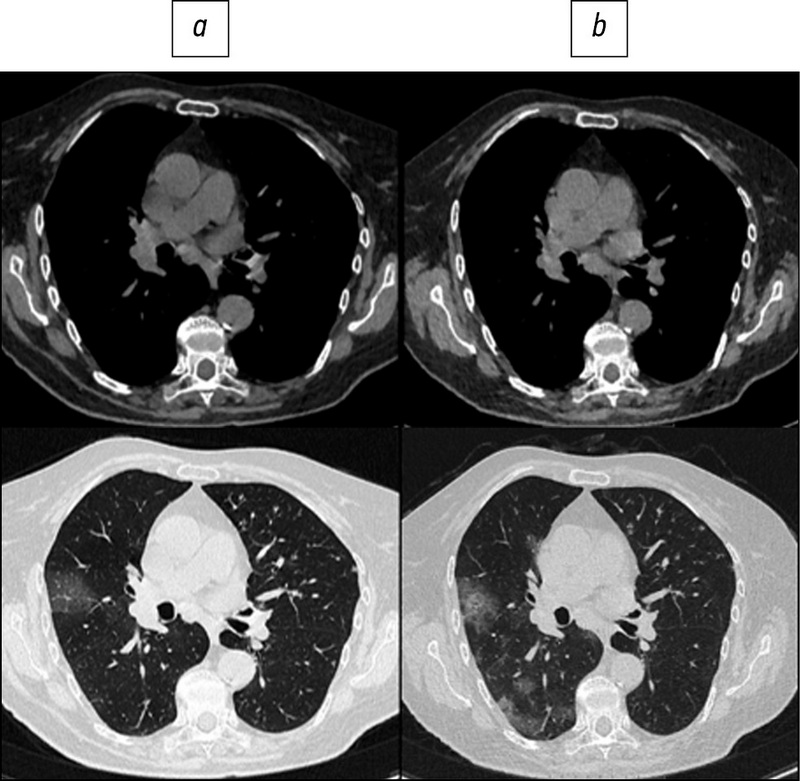 Opportunities to reduce the radiation exposure during computed tomography to assess the changes in the lungs in patients with COVID-19: use of adaptive statistical iterative reconstruction