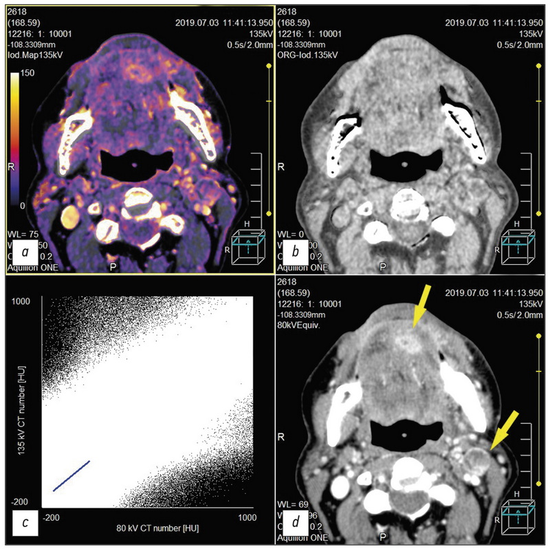 Dual-energy computed tomography for head and neck cancer