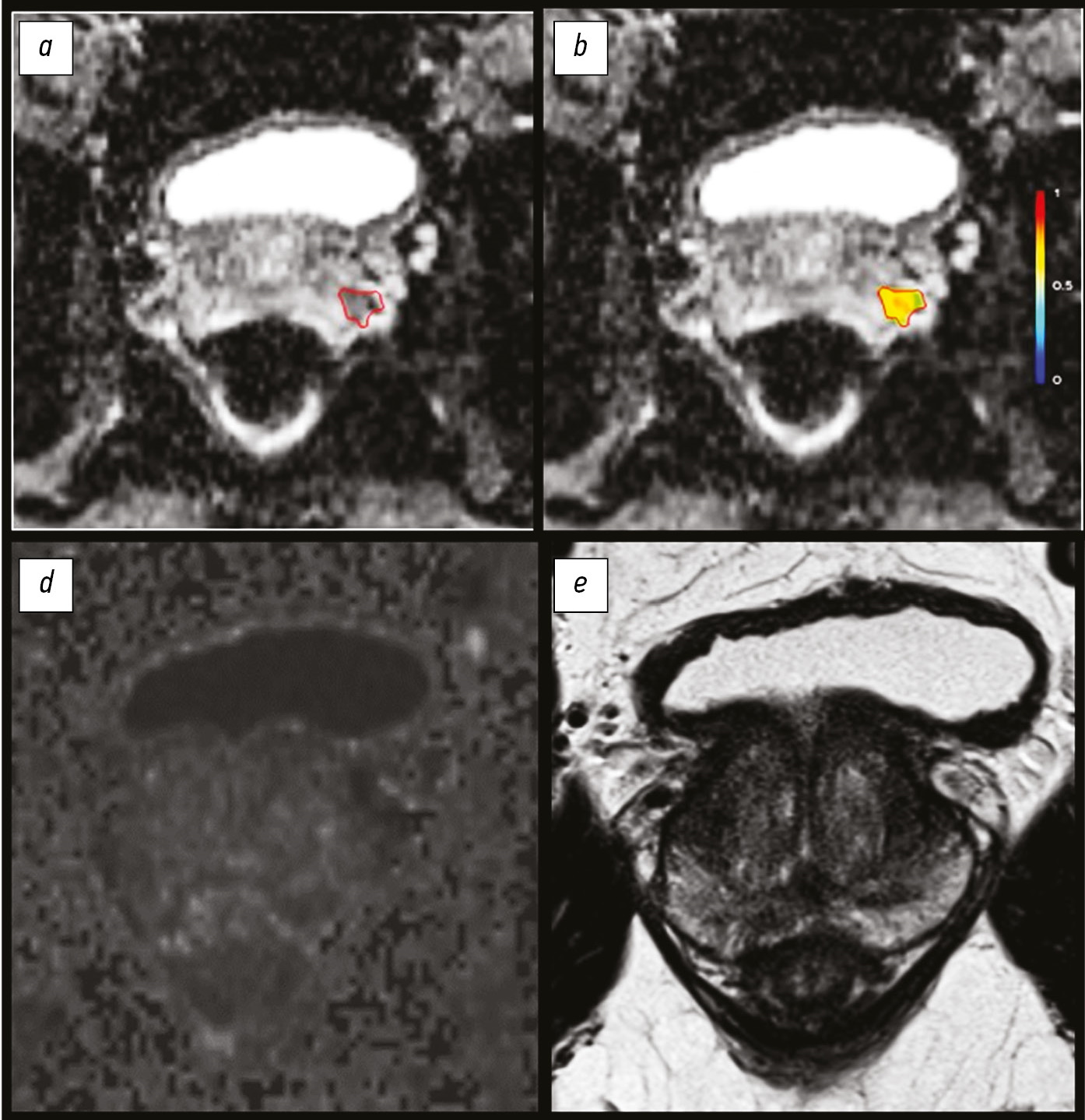 Magnetic resonance imaging radiomics in prostate cancer radiology: what is currently known?