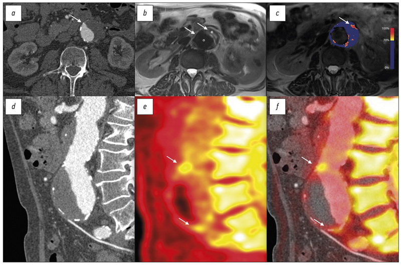 Emerging techniques in atherosclerosis imaging
