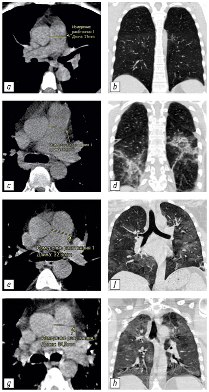 Changing of pulmonary artery diameter in accordance with severity of COVID-19 (assessment based on non-contrast computer tomography)