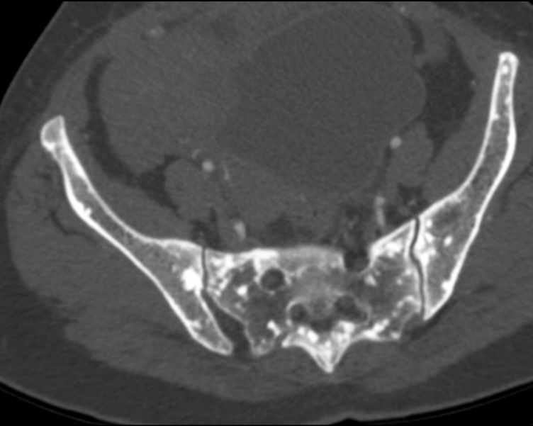 Osteopoikilosis in the ribs, pelvic region and spine: a case report
