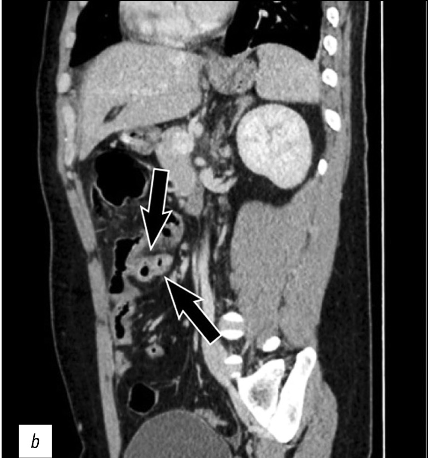 Perforated Meckel’s diverticulum in a young male patient: a case report