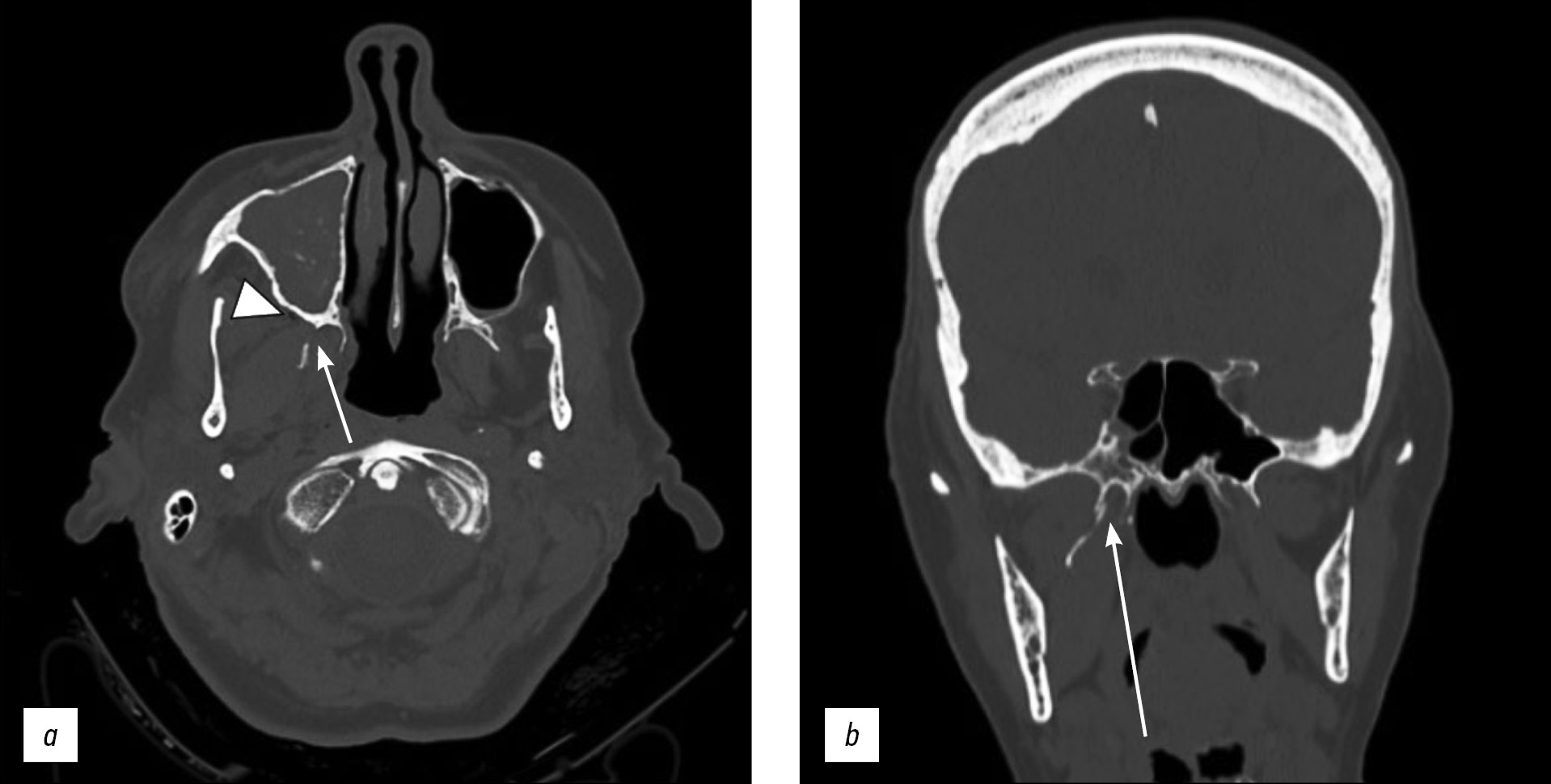 Unilateral isolated fracture of the pterygoid plate: a case report